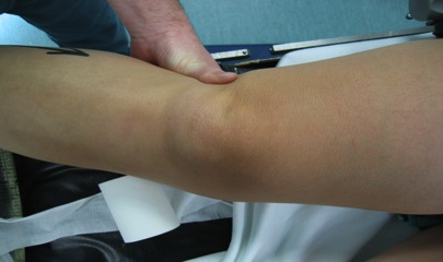 Knee dislocation lateral instability
